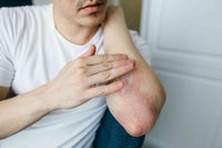 Eczema and Dermatitis