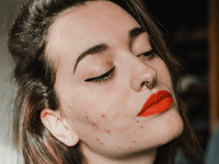 Acne Treatment